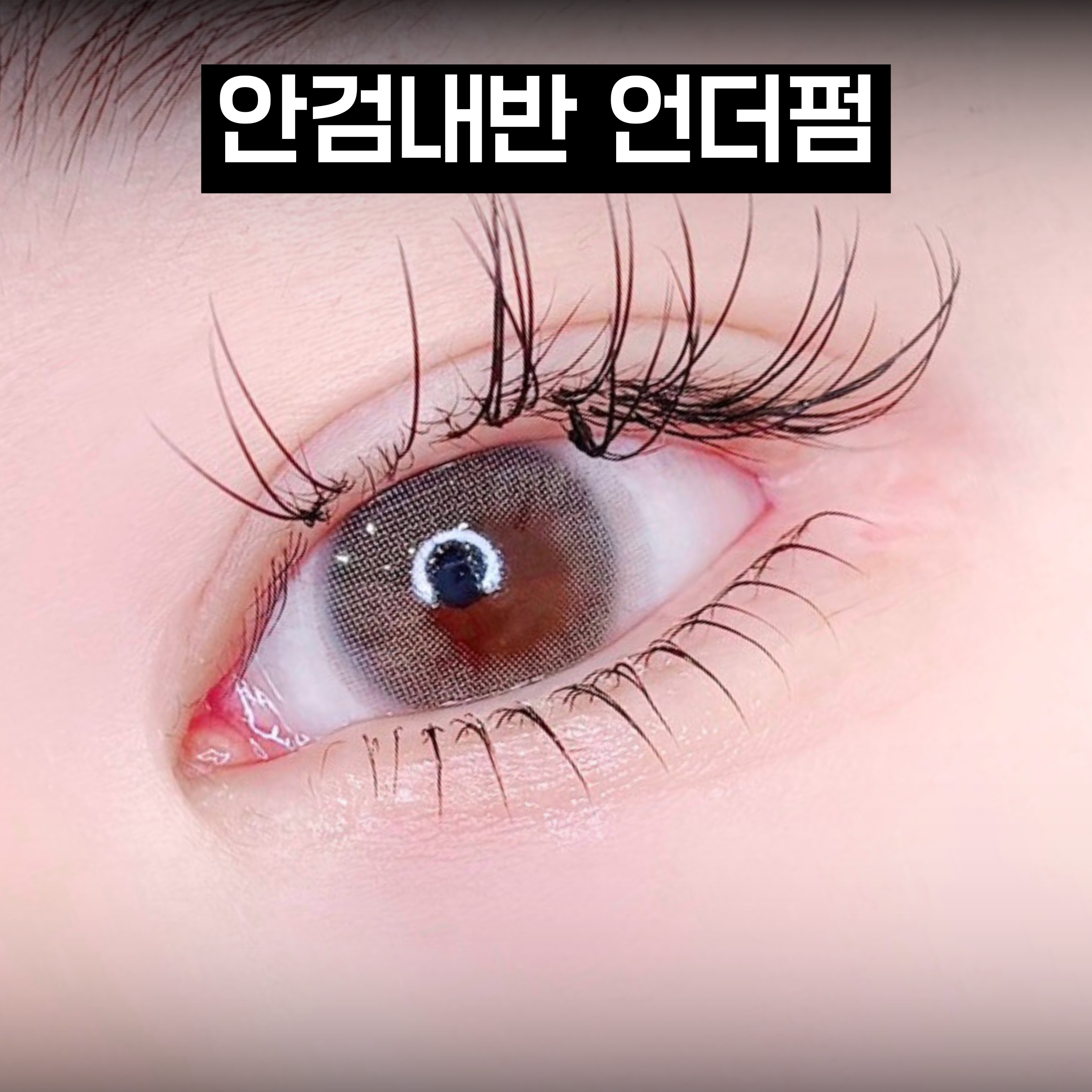 언더펌 시술 결과 4